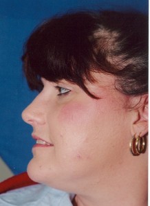 Obagi Treating Acne After | Dr. Lisa Bunin Obagi Treating Acne After | Dr. Lisa Bunin | Allentown PA