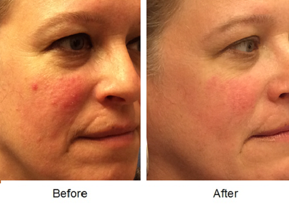 Rosacea 1 71116 IPL Light Treatment