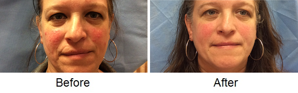Rosacea 2 71116 IPL Light Treatment