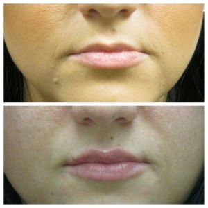 Restylane Silk Patient | Lip Filler | Dr. Lisa Bunin