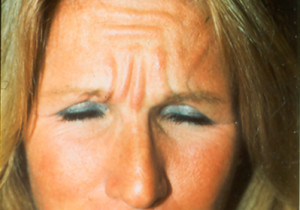 Before Frown Botox | Dr. Lisa Bunin | Before and After Photos | Allentown PA