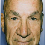 Blepharoplasty Male Patient After | Eyelid Surgery Before and After Photos | Dr. Lisa Bunin | Allentown PA