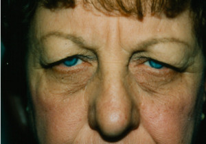 Eyelift Patient Before | Blepharoplasty | Before and After Photos | Dr. Lisa Bunin | Allentown PA