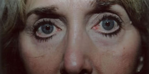 Laser Resurfacing Patient Before | Before and After Photos | Dr. Lisa Bunin