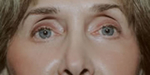 Laser Resurfacing Patient After Lower Eyelid Surgery | Before Laser Resurfacing | Dr. Lisa Bunin Laser Resurfacing Patient After Lower Eyelid Surgery | Before Laser Resurfacing | Dr. Lisa Bunin