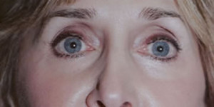 Laser Resurfacing Patient After Lower Eyelid Surgery | After Laser Resurfacing | Dr. Lisa Bunin