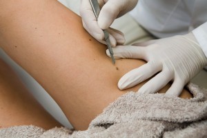 Dr. performing lesion removal - Dr. Lisa Bunin - Allentown PA