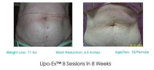 Lipo-Ex Stomach Patient 2 | Before and After | Dr. Lisa Bunin non-surgical fat removal Lipo-EX