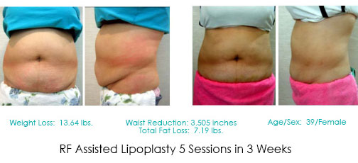 Non-surgical fat remval Lipo-Ex 