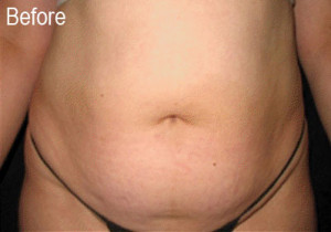 Lipo-E on Stomach | Female Patient After | Before and After Photos | Dr. Lisa Bunin | Allentown PA
