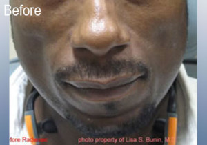 African American Male Radiesse Patient Before | Before and After Photos | Dr. Lisa Bunin | Allentown PA