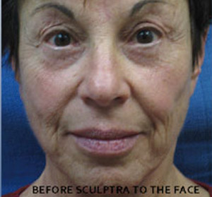 Sculptra Patient 2 Before | Front View | Before and After Photos |Dr. Lisa Bunin | Allentown PA