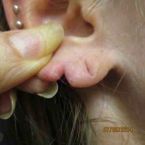 Earlobe repair Before | Allentown, PA