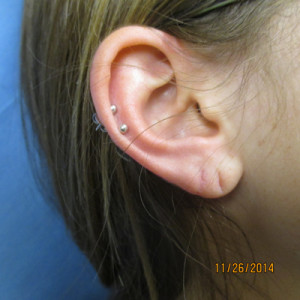 torn earlobe after repair, Allentown, PA