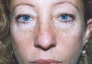 Eyelift Patient Before | Uppper Eyelid | Blepharoplasty | Before and After Photos | Dr. Lisa Bunin | Allentown PA