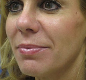 Voluma R Patient 1 After | Side View | Radiesse | Before and After Photos |Dr. Lisa Bunin | Allentown PA