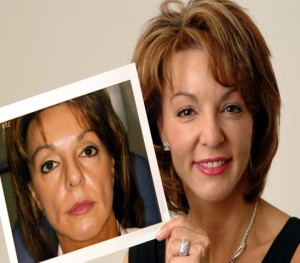 Fillers Example | Before and After Photo | Dr. Lisa Bunin | Allentown PA