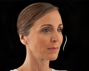 Voluma Patient 1 After | Dr. Lisa Bunin | Allentown PA