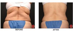 Zerona Before and After Back | Dr. Lisa Bunin | Allentown PA