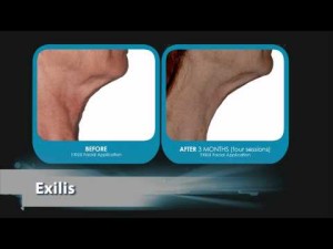 Dr. Marcia Byrd | Atlanta Exilis Skin Tightening