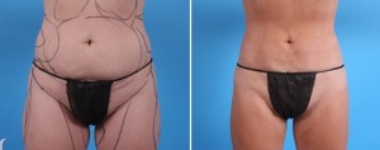 Abdomen Liposuction | Atlanta | Before and After Photos | Dr. Marcia Byrd