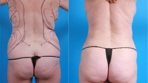 | Atlanta | Before and After Photos | Dr. Marcia Byrd