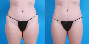 | Atlanta | Before and After Photos | Dr. Marcia Byrd