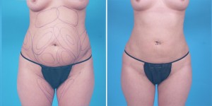 | Atlanta | Before and After Photos | Dr. Marcia Byrd