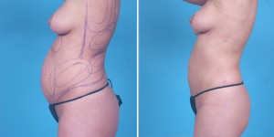 | Atlanta | Before and After Photos | Dr. Marcia Byrd