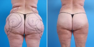 | Atlanta | Before and After Photos | Dr. Marcia Byrd