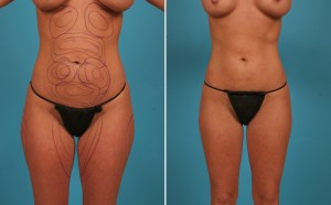 | Atlanta | Before and After Photos | Dr. Marcia Byrd