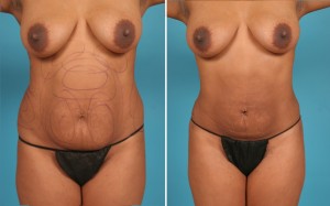 | Atlanta | Before and After Photos | Dr. Marcia Byrd