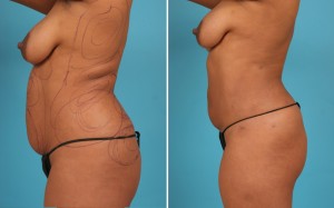 | Atlanta | Before and After Photos | Dr. Marcia Byrd