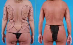 | Atlanta | Before and After Photos | Dr. Marcia Byrd