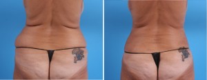 | Atlanta | Before and After Photos | Dr. Marcia Byrd