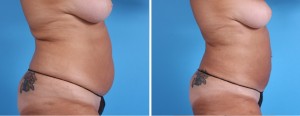 | Atlanta | Before and After Photos | Dr. Marcia Byrd