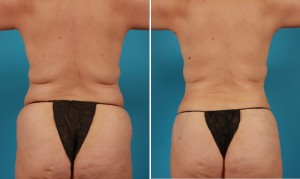 | Atlanta | Before and After Photos | Dr. Marcia Byrd