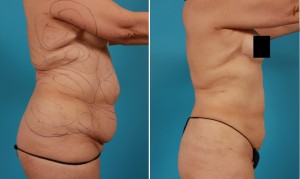 | Atlanta | Before and After Photos | Dr. Marcia Byrd
