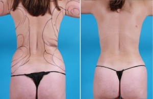 | Atlanta | Before and After Photos | Dr. Marcia Byrd