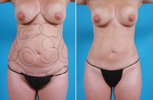 | Atlanta | Before and After Photos | Dr. Marcia Byrd