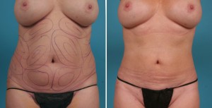 | Atlanta | Before and After Photos | Dr. Marcia Byrd