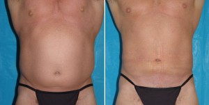| Atlanta | Before and After Photos | Dr. Marcia Byrd