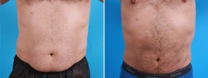 | Atlanta | Before and After Photos | Dr. Marcia Byrd