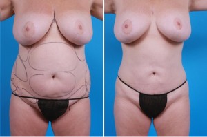 | Atlanta | Before and After Photos | Dr. Marcia Byrd