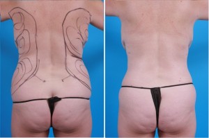 | Atlanta | Before and After Photos | Dr. Marcia Byrd