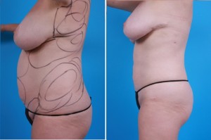 | Atlanta | Before and After Photos | Dr. Marcia Byrd