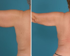 | Atlanta | Before and After Photos | Dr. Marcia Byrd