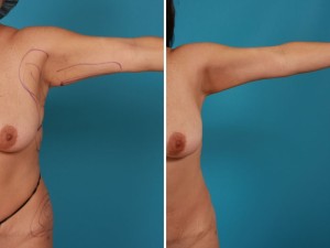 Arm Lift | Atlanta | Before and After Photos | Dr. Marcia Byrd