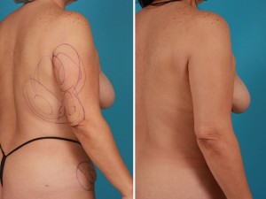 Arm Lift | Atlanta | Before and After Photos | Dr. Marcia Byrd