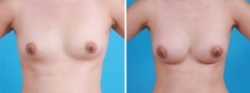 Breast Augmentation | Atlanta | Before and After Photos | Dr. Marcia Byrd